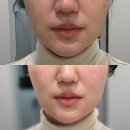 압구정본산부인과의원 | 스레드에서 유명한 압구정피부과 아르나의원 온다리프팅 솔직후기