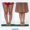 휜 다리교정 4개월후 플레어스커트 이뻐요! 이미지