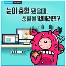 눈 충혈, 충혈 없애기! 이미지