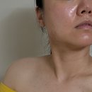 가을의원 | 중계의원 쥐젖 비립종 리터치 받은후기