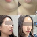 온다리프팅 원리 효과 콜라겐 생성 극초단파 통증 뜨거움 유지기간