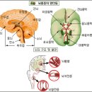 腦卒中(中風) 이미지