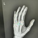 더원정형외과의원 | 중수골 골절 2년 경과 | 손바닥뼈 골절 비수술 치료 후기