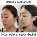 11305-15-400-1 | 창원피부과 슈링크 유니버스 잘하는곳 400샷 시술후기
