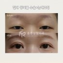 쌍꺼풀 수술 눈매교정 후기 강남 훌륭 성형외과 쌍수 3개월차 후기