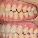 스마일라인치과의원 | 강남치과 무삭제라미네이트 완전 무삭제로 가능한가요?