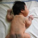 몽고반점 이미지