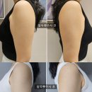 논현센타약국 | 팔뚝지방분해주사, 다이어트 마스터 플랜 의원 뺏주사 후기
