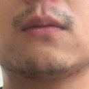 원명파크 | 인천논현피부과 | 남성 수염 제모, 아포지엘리트플러스 3회차 후기 및 효과