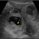 Ectopic pregnancy 이미지