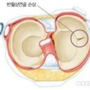 무릎관절질환의 증상과 치료 이미지