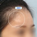 초이성형외과의원 | 이마 필러 부작용? 필러 녹이기 제대로 하자! [초이성형외과]