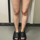 [서울/람스후기] 허벅지람스 지방분해주사 통증 붓기 / 라인변화 4주차 후기!