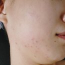 산본피부관리 리스 에스테틱 여드름 집중 케어