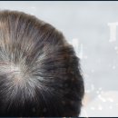 모든모의원 - 중구 약령길 8 | 압구정 모발이식만 하면 무조건 20대 머리숱으로 돌아갈 수 있다고? 현실적 기대가 중요한 이유
