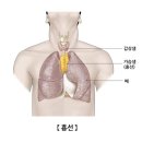 "흉선 절제, 사망 위험↑" 이미지