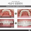 신대방역치과의 어금니임플란트, 그 가격 이상의 가치 이미지