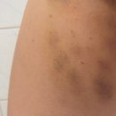 명동건강사우나 | 명동다이어트 제로팻주사 첫 1회차 후기 허벅지지방분해주사 내돈내산 솔직 후기