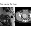 Adenomyosis of the uterus 이미지
