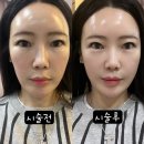 유진피부과의원 | 연예인 리프팅 티타늄리프팅은 강남역피부과 추천