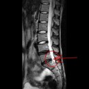 허리디스크 치료사례 -16(한*숙님 F/33세) 요추5-천추1번간 추간판 탈출증 치료 전-후 사진 비교편 이미지
