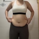 복부지흡 인천지방흡입 7주차 후기, 가격, 통증