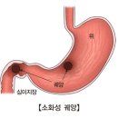 십이지장 궤양[Duodenal ulcer소화기질환] 이미지