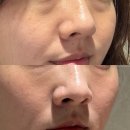 역삼동 피부과 다크서클필러 받고 전후 솔직후기!