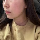 박흥수일반외과의원 | 강남 성형외과 소개팅주사 온다리프팅 1주일 후기