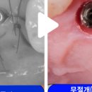 에이플란트치과의원 네이버블로그