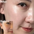 구영시스템 | 강남 써마지 300샷 리쥬란 2cc 후기 효과 가격 2주 경과 솔직후기