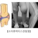 류마티스 관절염 초기증상 예방하려면 이건 무조건 챙기세요 이미지