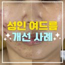 롯데쇼핑 (주)광주점 | 광주 성인여드름 반복된다면? 피부과·1년 관리 후에도 효과 없던 30대 간호사 사례