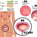 남자보다 여자가 더 잘걸리는 것 8가지 이미지