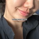 팔자주름리프팅 귀족침 한달차 후기 한의원 리프팅