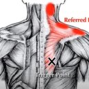 운동으로 인한 근육통(myalgia) 과 항암 치료 부작용으로 인한 근육통증 이미지