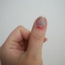 반석메디칼 | 재생밴드 사용으로 상처빨리낫는법