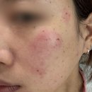 빨간문약국 | 편평사마귀 제거 후기(1주차), 내돈내산, 메디폼 알러지 치료기