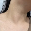 제일레이저(주) | 홍대입구역피부과 쥐젖제거 CO2레이저 리얼후기 성공적