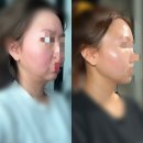 (내돈내산) 공덕 피부과 페이스 피부과에서 울쎄라+써마지+티타늄 받은 개쩌는 후기