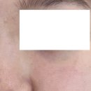 필노래 | :: 천호 에스테틱 추천 :: 스킨앤유 천호점 꼼꼼한 피지,모공청소 아쿠아필 후기