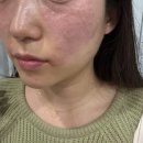 [미작뷰티 시흥점] 시흥 배곧 피부관리 기미잡티 제거 / 시흥 주근깨 제거