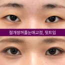 아이케이성형외과의원 네이버블로그