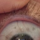 제이유의원 | 제이유 피부과 아이라인 문신 제거 3차 후기