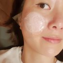 로담한의원 새살침 후기 여드름흉터 제거로 매우 만족