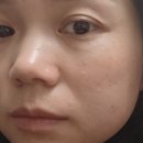녹두의원 | 기미 잡티레이저 비용 상세비교 집에서 장희빈미안법 후기