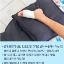 족부궤양 이미지