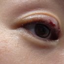 칼로달 | 겉다래끼 칼로 긁어 없앤 후기