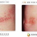 가산곧바로의원 네이버블로그
