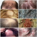 샬롬 중화요리 | '염증+가려움+각질+건조한 두피, 건선두피, 건조한 두피의 탈모' 홈 관리법